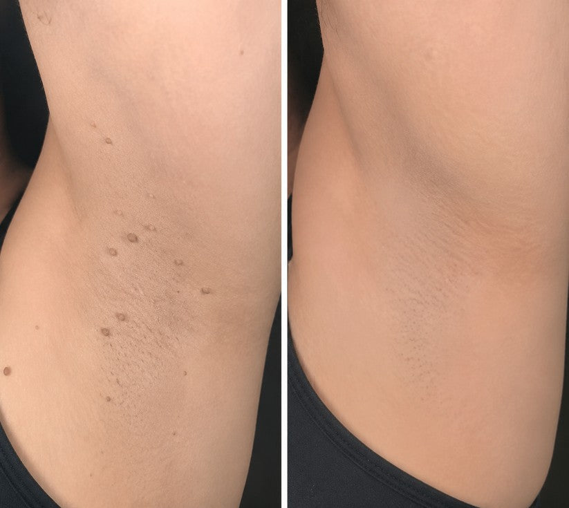 👍GFOUK® 2-in-1 Microneedle & Hydrocolloid Patch🍀 | Removes raised moles, acne, flat warts, and skin tags | Invisible patches for face and body