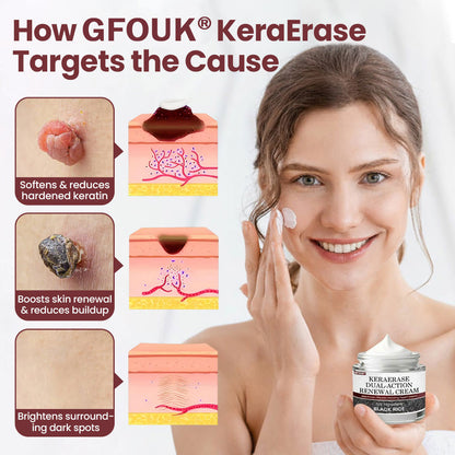 🔥Last Day 70% OFF🔥GFOUK® KeraErase Dual-Action Renewal Cream