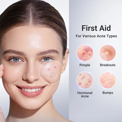 ⏰LAST DAY BUY 2 GET 2 FREE✨DR.Fachmer® 24H Acne & Pimple Treatment Drying Lotion | Inflammation Relief, Post-Blemish Care & High Pressure Pimple Relief