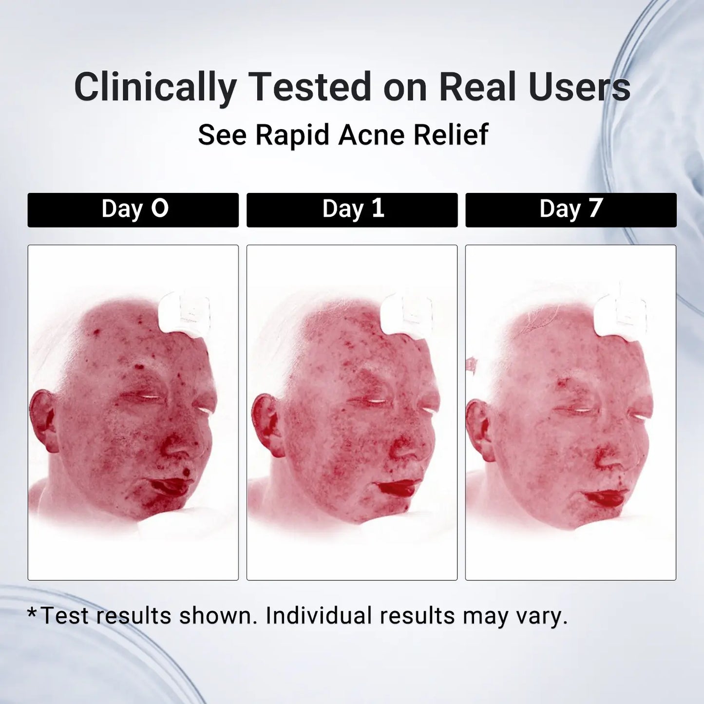 ⏰LAST DAY BUY 2 GET 2 FREE✨DR.Fachmer® 24H Acne & Pimple Treatment Drying Lotion | Inflammation Relief, Post-Blemish Care & High Pressure Pimple Relief