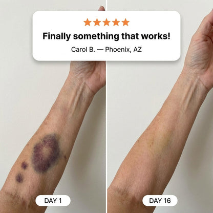 💥75K+ SOLD💕- Rolimey® Bruise Repair & Skin-Strengthening Cream