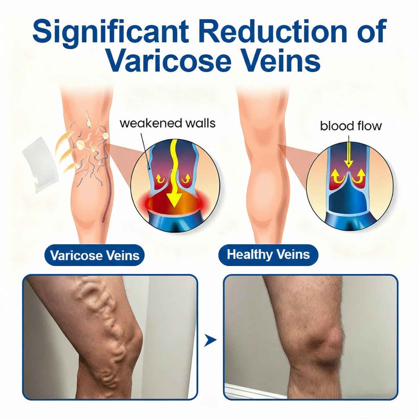 🇺🇸👨‍⚕️✅GFOUK® VeinEase Microneedle Care Patch⚡Instant Relief, Long-Term Results