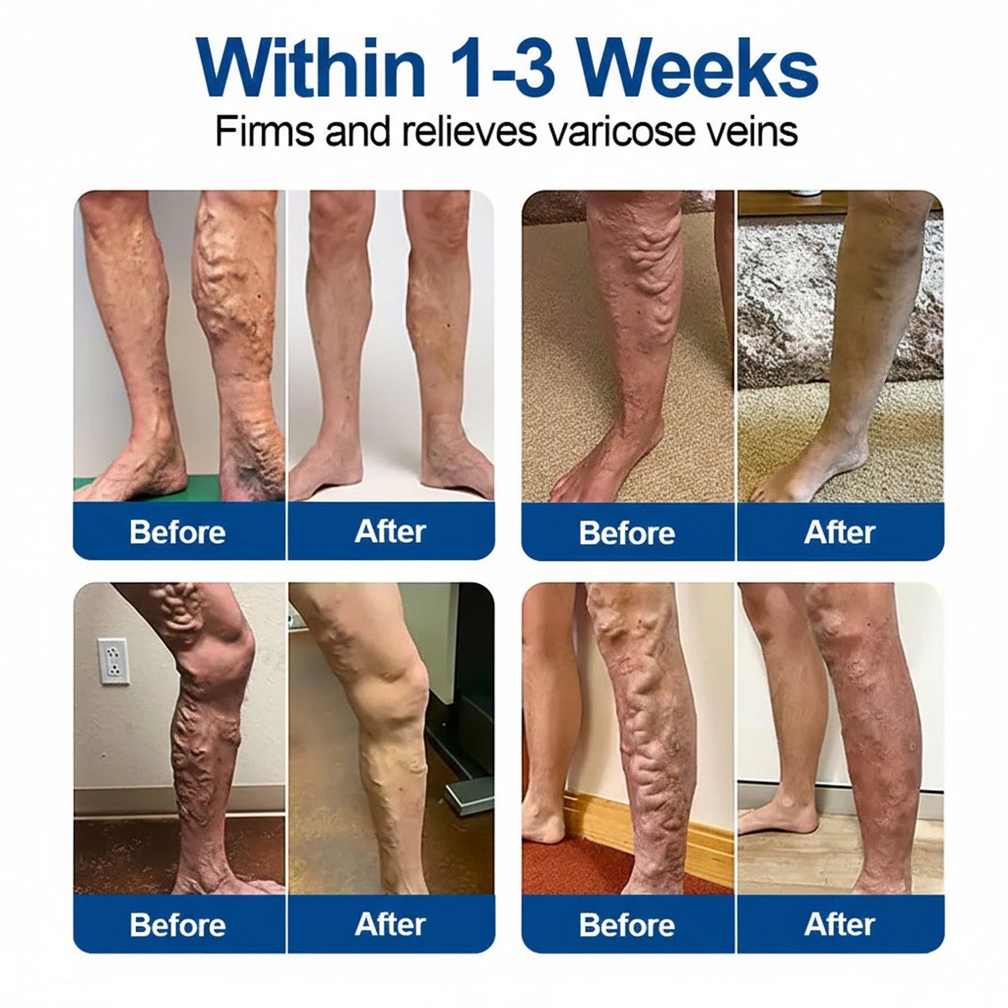 🇺🇸👨‍⚕️✅GFOUK® VeinEase Microneedle Care Patch⚡Instant Relief, Long-Term Results