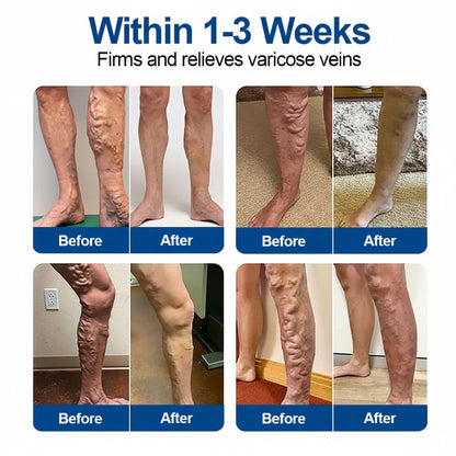 🇺🇸👨‍⚕️✅GFOUK® VeinEase Microneedle Care Patch⚡Instant Relief, Long-Term Results
