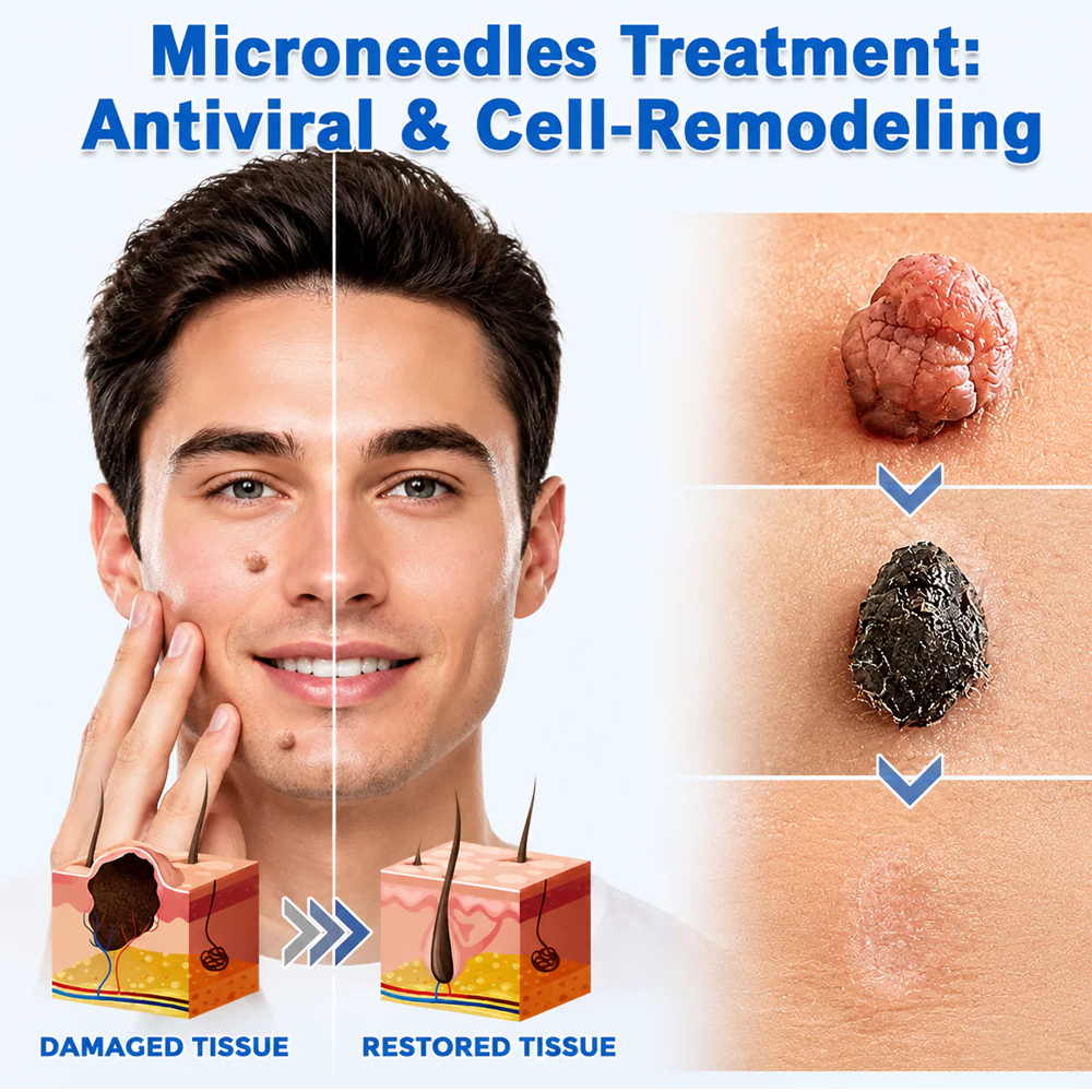 ✨GFOUK® 2-in-1 Microneedle & Hydrocolloid Patch🍀 | Removes raised moles, acne, flat warts, and skin tags | Helps improve wrinkles, scars, and blemishes | Invisible patches for face and body