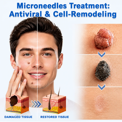 ✨GFOUK® 2-in-1 Microneedle & Hydrocolloid Patch🍀 | Removes raised moles, acne, flat warts, and skin tags | Helps improve wrinkles, scars, and blemishes | Invisible patches for face and body