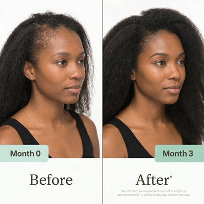 🔥Last Day 50% OFF🔥Hudros® Hair Activator Oil